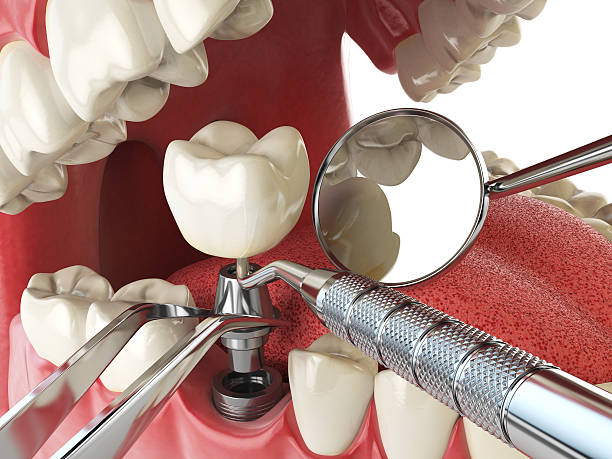 Best Emergency Dental Care for Broken or Chipped Teeth in Gun Barrel City, TX