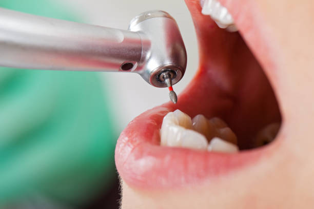 Best Emergency Tooth Extraction in Gun Barrel City, TX
